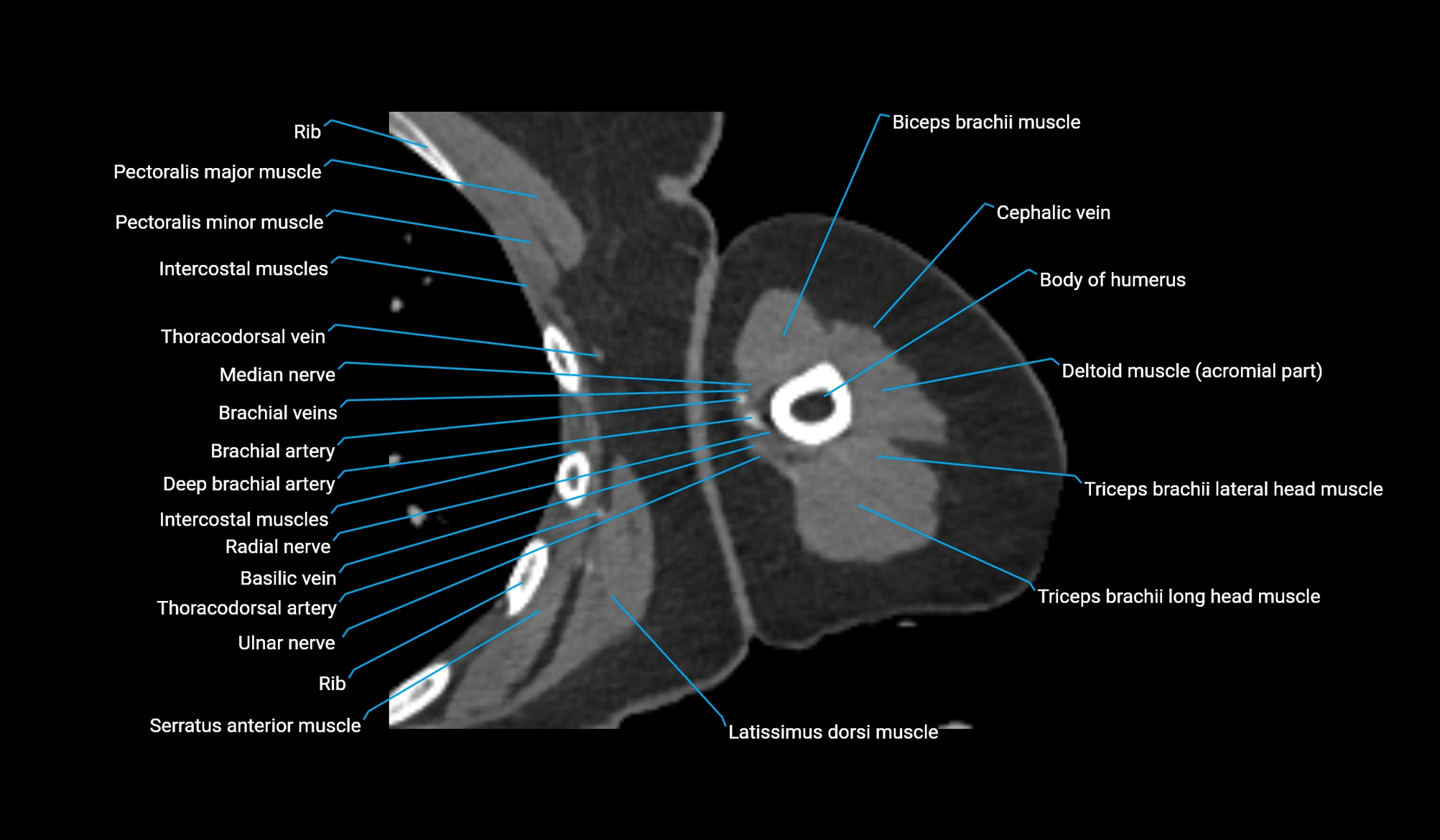 CT upper arm axial  cross sectional anatomy labelled radiology image -00188.webp